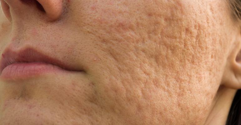 Topical treatment reduces scar formation in acne