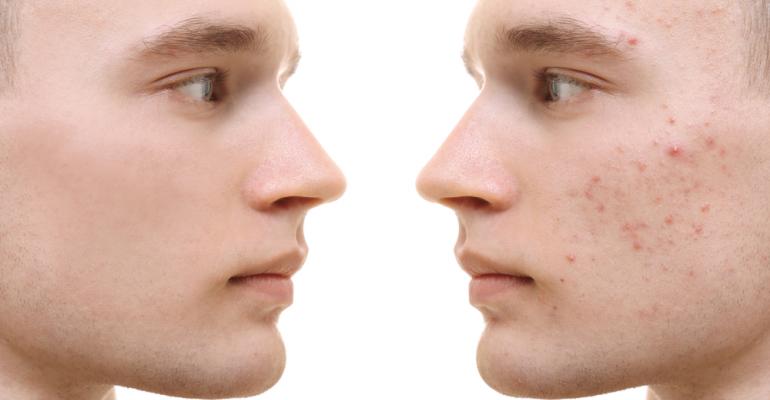 The science behind acne scarring 