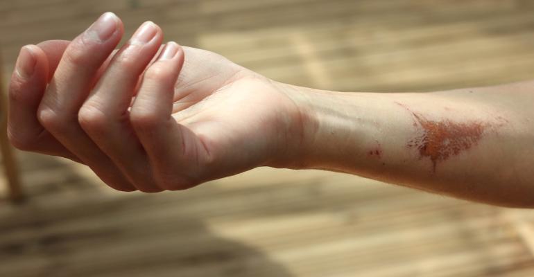 Scientists May Have Discovered A ‘Holy Grail’ For Healing Scars